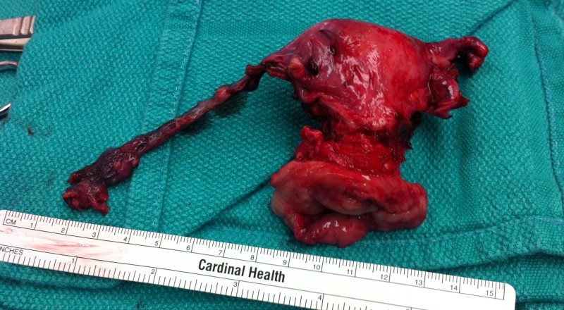 A uterus post surgery, placed on a surgical outfit.
